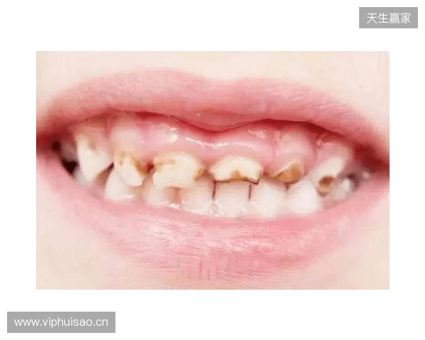 韦林顿确诊上唇部贯通伤；11、21牙半脱位；上颌前牙区牙槽骨骨折